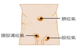 成人脐疝形成过程视频,从胚胎发育到病状显现-第1张图片-成年电影网