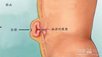 成人脐疝形成过程视频,从胚胎发育到病状显现-第2张图片-成年电影网