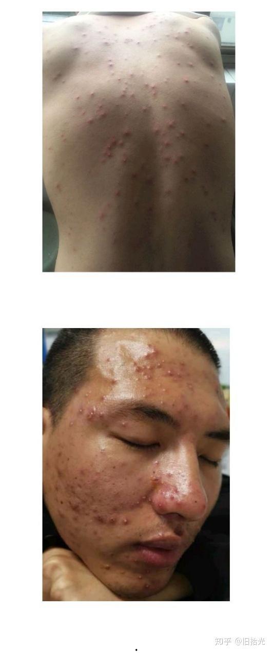 成人水痘的恢复过程视频,症状演变与康复过程-第1张图片-成年电影网